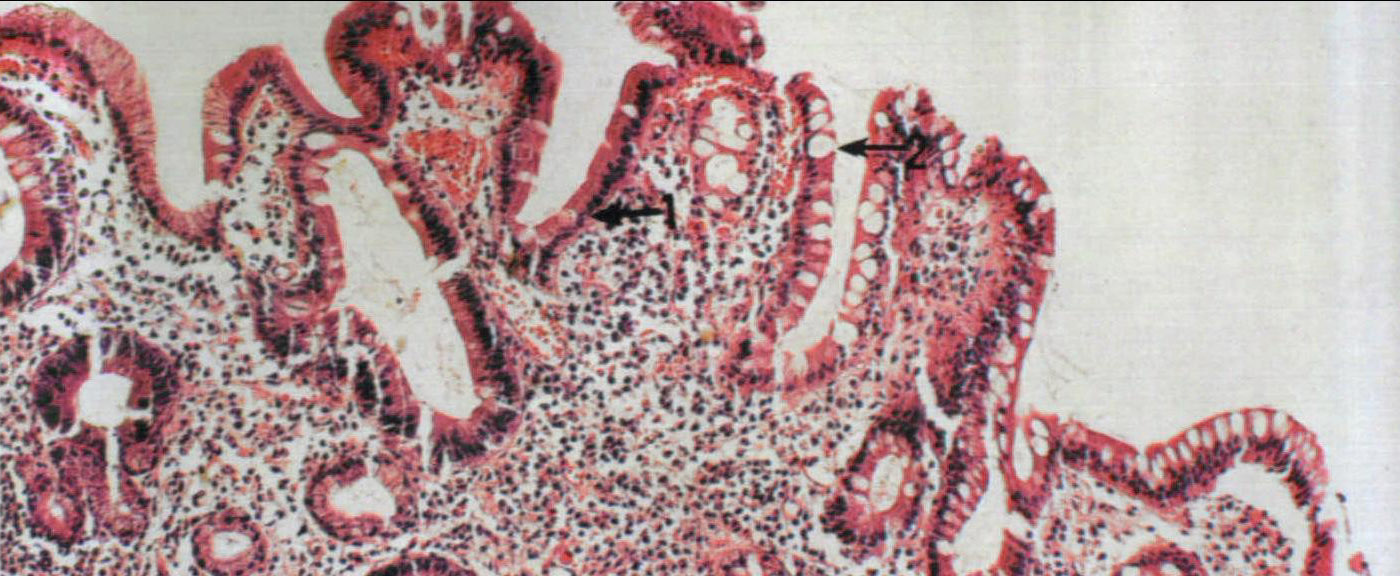 图9 胃粘膜肠上皮化生
